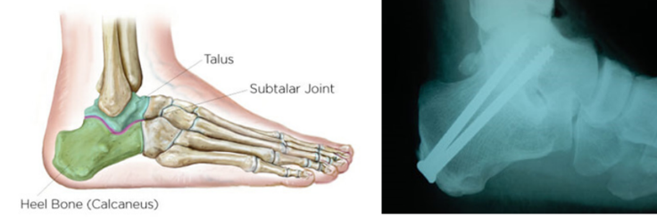 royal-orthopaedic-hospital-subtalar-joint-fusion